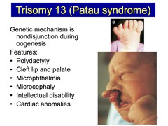 <p>- Severe Intellectual Disability (no separation of brain hemispheres)</p><p>- Extra fingers or toes (polydactyl)</p><p>- Cleft lip/palate</p><p>- Very small or absence of eyes</p>