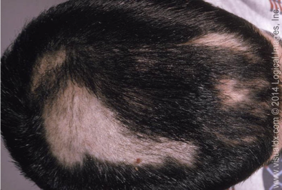 <p>What does this refer to</p><ul><li><p>Disorder in which individuals repeatedly pluck hairs from the scalp or other hair-bearing areas</p></li><li><p>Psychiatric disorder included in the DSM</p></li><li><p>Areas of alopecia may have irregular, bizarre shapes</p></li></ul><p></p>