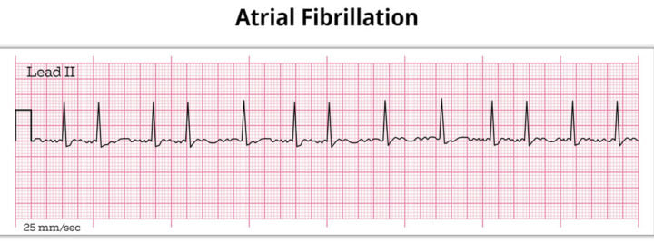 <p>Irregularly irregular rhythm with disorganized atrial activity and absence of P waves</p><p>-RF: HTN, valvular disease, CAD, HF, hyperthyroidism, OSA</p><p>-Dx: EKG, ECHO, CBC, TSH, CMP, BNP</p><p>-Tx: unstable needs immediate synchronized cardioversion, stable patients can be rate controlled first with beta blocker (metoprolol) or CCB (diltiazem), rhythm control for symptomatic/HF/young patients, anticoagulation with DOAC</p>