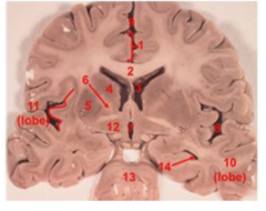 <p>B. Left lateral sulcus</p>