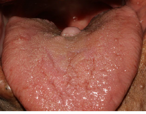 <ul><li><p>as the most common type of peripheral nerve neoplasms</p></li><li><p>a mixture of cell types, including Schwann cells and perineural fibroblasts</p></li><li><p>skin as the most frequent location</p></li><li><p>tongue and buccal mucosa as the most common intraoral sites</p></li><li><p>on rare occasions, the tumor can arise centrally within the bone</p></li><li><p>solitary or syndrome-related</p></li><li><p>multiple lesions associated with neurofirbomatosis </p></li></ul><p></p>