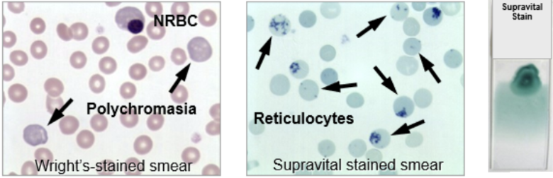 <p><span style="background-color: transparent;">Discuss manual reticulocyte counts including each of the following:</span></p><ul><li><p><span style="background-color: transparent;"><strong>Procedure and principle of supravital stains</strong></span></p></li><li><p><span style="background-color: transparent;"><strong>Sources of error</strong></span></p></li><li><p><span style="background-color: transparent;"><strong>Normal reference values expressed in both relative and absolute numbers</strong></span></p></li></ul><p></p>