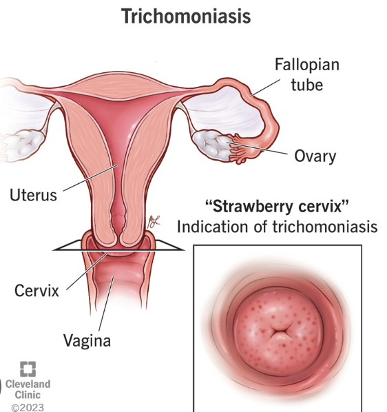 <p>trichomonas </p>