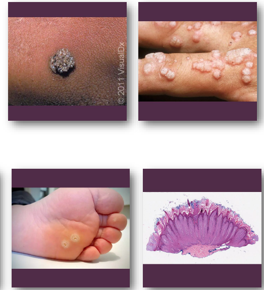 <p>• Many lesions <strong>regress spontaneously</strong> over time</p><p>•<strong> Topical or cryotherapy used for skin lesions</strong></p><p>• Surgical removal if diagnosis is uncertain</p><p>• Recurrence uncommon after adequate treatment</p><p>• No evidence of malignant transformation</p>