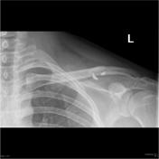 <p>clavicle, acromion to sternum, lateral and superior soft tissue margins </p>