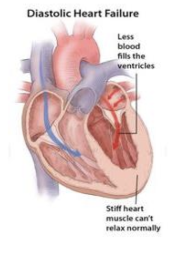 <p>Diastolic heart failure is when the <strong>ventricles</strong> <strong>cannot</strong> <strong>relax</strong> <strong>properly</strong>, making it <strong>difficult</strong> for the <strong>heart</strong> to <strong>fill</strong> with <strong>enough</strong> <strong>blood </strong>during<strong> diastole</strong></p>