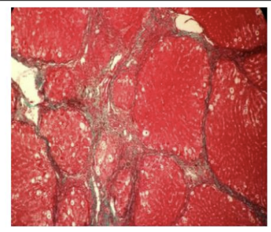 <p>Proliferated hepatocytes arranged in thick plates and separated by blood sinusoids. Central vein in abnormal sites (eccentric). Hepatocytes may be small, large, or binucleate.</p>