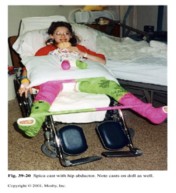 <p><span>cast used to stabilize the hip or femur in infants and children after surgery for hip dysplasia or femur fractures</span></p><ul><li><p><em>never</em> use bar to reposition </p></li></ul><p></p>