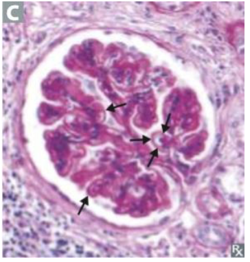<p>This condition is associated with a “spike and dome” appearance on LM.</p>