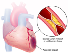 <p>myocardial infraction</p>