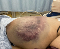<p>Rapid accumulation of blood in a surgical cavity, occurring 6-24 hours postop </p><p>-Presentation: sudden breast enlargement that is painful, skin may appear purple </p><p>-Tx: return to OR </p>