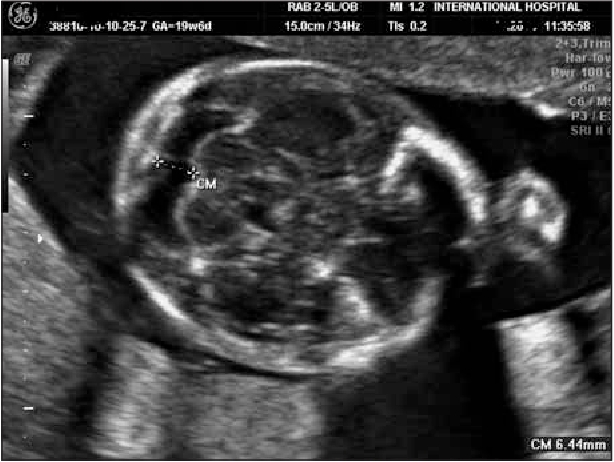 <p><span>How do you properly measure the cisterna magna size?</span></p>