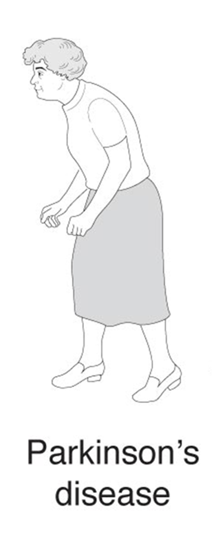 <p>parkinson’s disease </p>