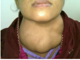 <p>Common in areas that have a <strong>deficiency in iodine, </strong>hypothyroidism, cold sensitivity, weight gain, fatigue, and autoimmune disease, where the immune system attacks the thyroid gland</p>