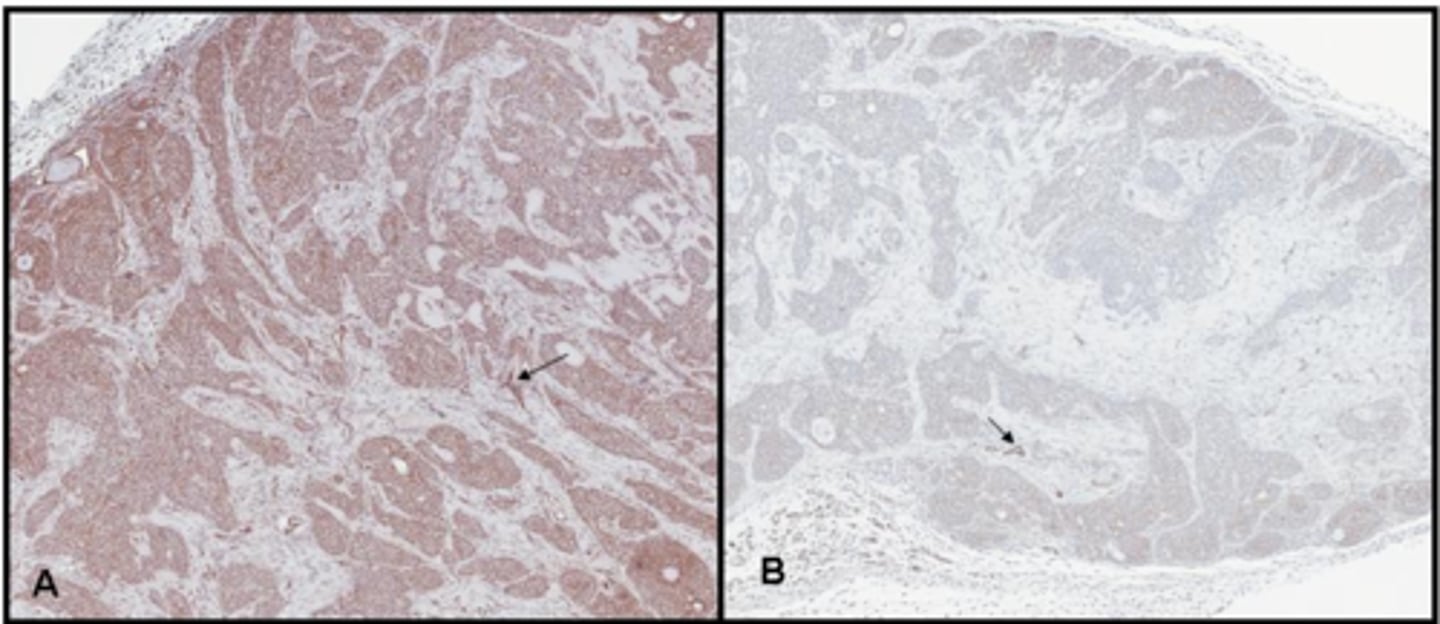 <p>B</p><p>Feedback:</p><p>Notice that image A has excessive background staining which masks the crisp clean staining of the blood vessels as shown in image B. Excessive background distracts from the true positive and diagnosis can be compromised A good technician is able to recognize background fram true positive staining and is able to troubleshoot and correct the problem.</p>