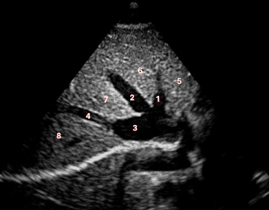 <p>Which of the following structures is labelled #1?</p><p>a. left hepatic vein</p><p>b. right hepatic vein</p><p>c. IVC </p><p>d. left portal vein </p>