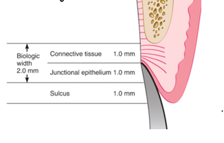 <p>-inflammation and/or uncontrolled bone loss if restorations impinge on biologic width</p>