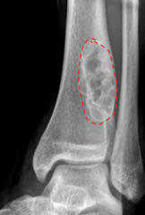<p>What is this?</p><p>- 8-20 yo, Male</p><p>- Asymptomatic</p><p>- Metaphyseal - Distal tibia</p>