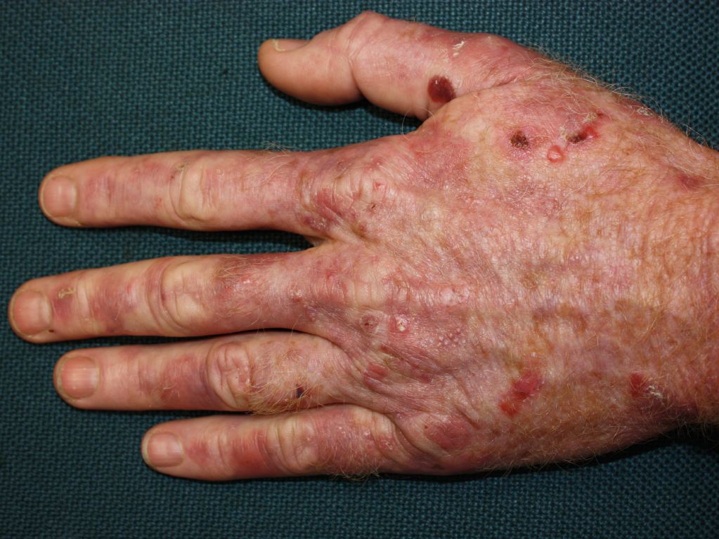 <p>Autosomal dominant: Inability to metabolize porphyrins; episodes of mental disturbance</p>