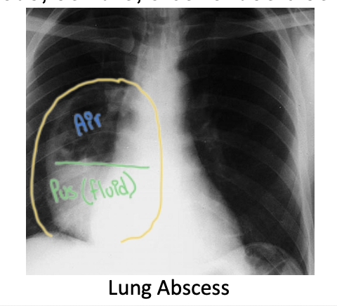 <p>Contained and localized pus collection in lungs; Cause: Aspirated <em>oral flora anaerobes</em> or <em>S aureus</em><br><br><strong><u>Presentation:</u></strong> Fever, night sweats, weight loss & cough with foul-smelling sputum (bc of pus)<br><br><strong><u>Imaging</u></strong>: X-ray shows ""air-fluid level"" cavitation filled with pus</p>