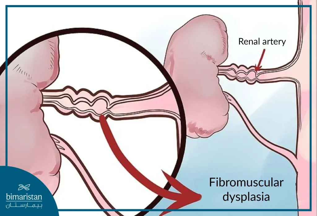 <p>Answer: A nonatherosclerotic, noninflammatory arterial disease.</p><p>Extra Information:</p><ul><li><p>It can narrow renal arteries and activate RAAS.</p></li></ul><p></p>