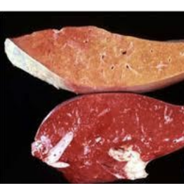 <p>Hepatic what condition in camelids presents with gradual weight loss then rapid decline, and tend to be pregnant females? Test liver parameters (albumin, globulins, GLDH, GGT, glucose), as well as ketones, NEFAs, triglycerides, bile acids, and clotting times.</p>