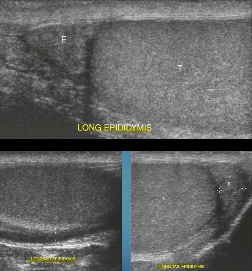 <p>Iso/hypoechoic compared with normal testicle; coarse in appearance compared to normal testicle; head is superior and posterior to testicle, body courses posterior, and tail lies at inferior aspect</p>