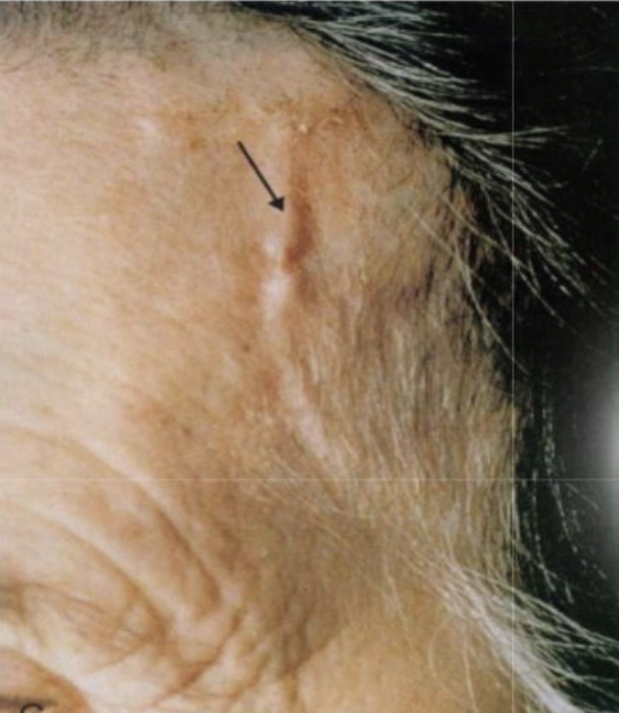 <p>Arterial segments develop nodular intimal thickening (with occasional thrombosis) that reduces luminal diameter that can lead to ischemia; can appear as palpable nodules on the scalp</p>