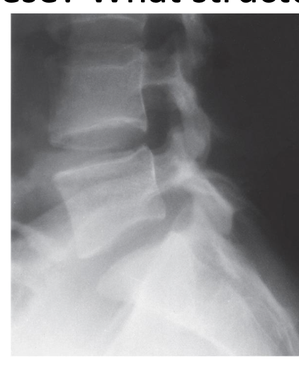 <p>What view of the lumbar spine is this?</p>
