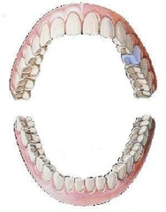 <p>maxillary left second bicuspid</p>