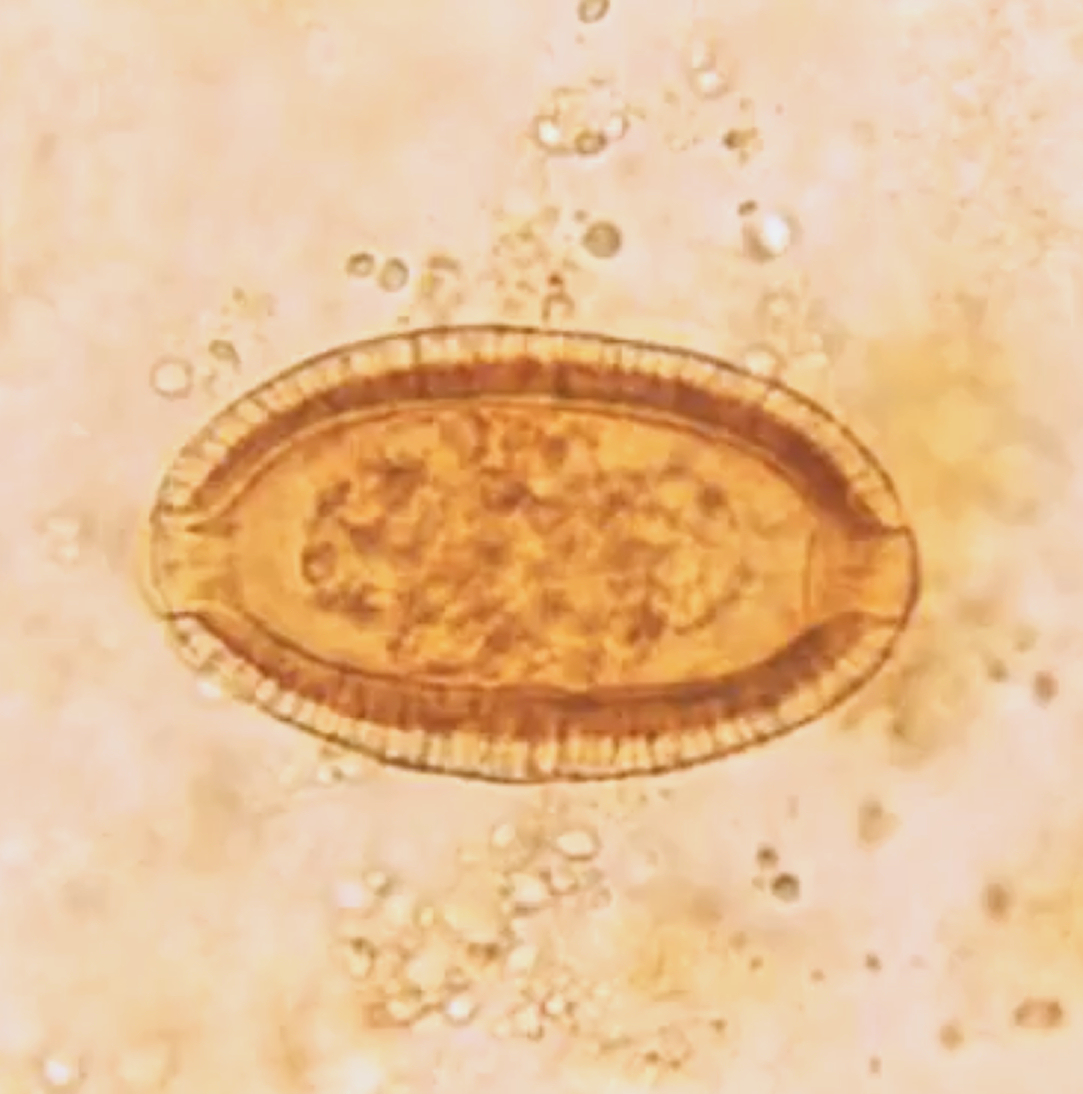 <p>resemble Trichuris trichiura (whipworm)<br><br>smaller with thick/striated shell, less prominent polar plugs</p>