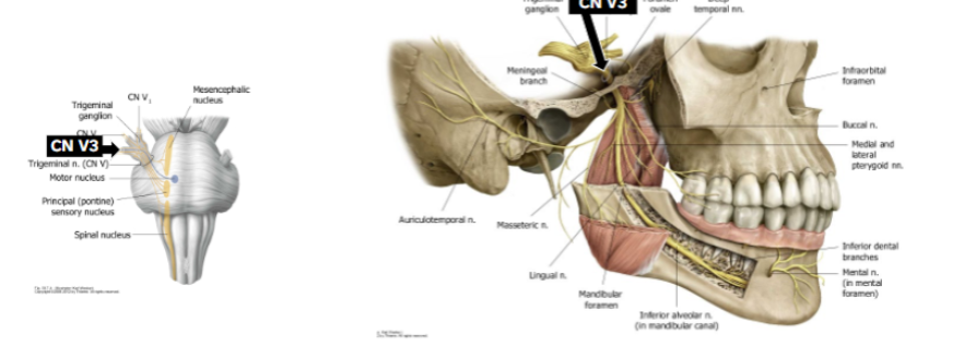 <p>Exits brain stem on lateral pons with all of CN V</p><p>Exits cranial cavity through foramen ovale</p><p>MOTOR to mm. of mastication, anterior digastric m., mylohyoid m., TVP, TTymp</p><p>SENSORY from meninges, skin of lower face &amp; parotid region, TMJ &amp; ear canal, lower teeth,</p><p>anterior 2/3 tongue (not taste)</p>