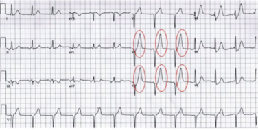 <ul><li><p>hyperkalemia</p></li></ul><p></p>