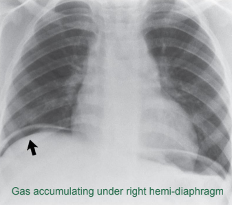 <p>Free air in the peritoneal cavity</p>