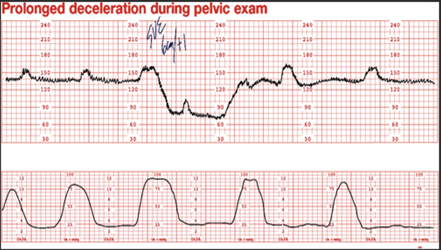 <p><strong>Prolonged deceleration </strong>: A decrease in FHR of > 15 beats per minute measured from the most recently determined baseline rate. The deceleration lasts >= 2 minutes but less than 10 minutes.</p><p><strong>Etiologies:</strong> Maternal hypotension, uterine hyperactivity, cord prolapse, cord compression, abruption, rapid decent of the fetal head, and maternal seizure</p><p></p>