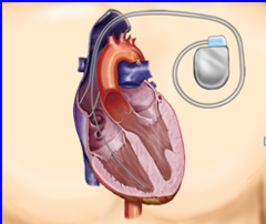 <p>implantable cardioverter defibrillator</p>