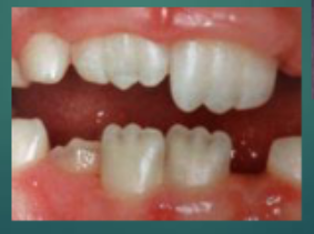 <p>One of three protrusions normally found on the incisal edge of permanent incisors incisal ridges of newly erupted incisors</p>