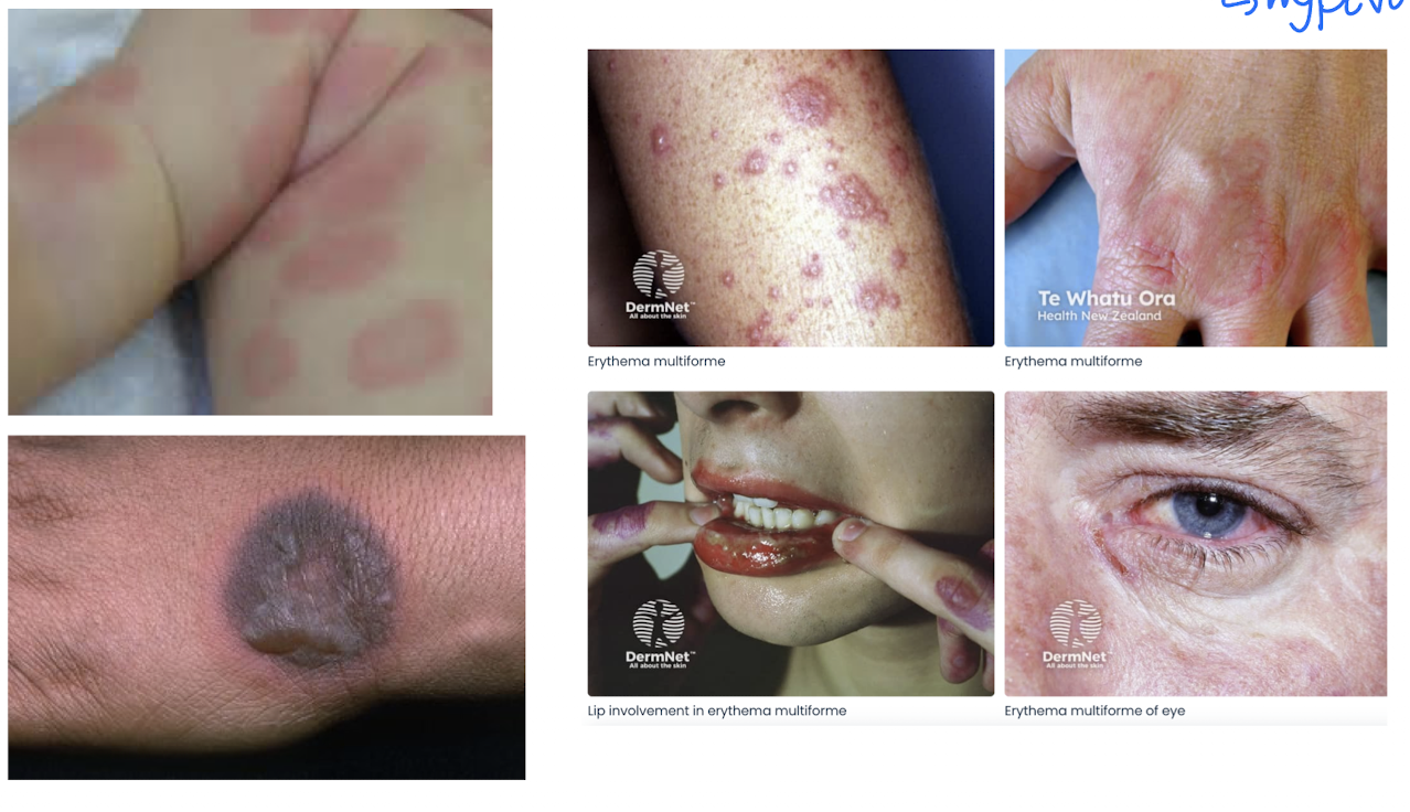 <p>A self-limiting skin reaction that commonly occurs after infection.</p><ul><li><p>macula patones</p></li></ul><p></p>