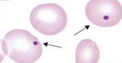 <p>Components: DNA nuclear fragments, fragment of nucleus that was extruded or fragments of chromosome separated by the mitotic spindle</p><p>Conditions Assoc: post-splenectomy, hemolytic anemia, megaloblastic anemia</p><p>Wright stain used</p>