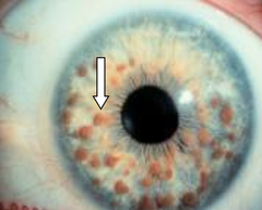 <p>cardinal features of neurofibromatosis type 1</p>