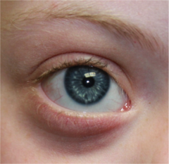 <p>- White spots in iris, found in Down syndrome</p>