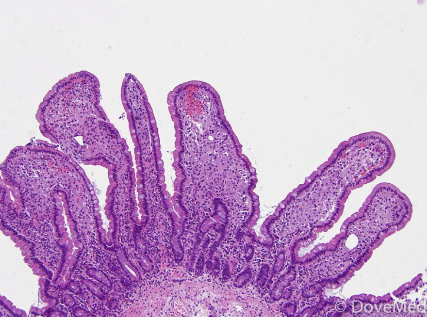 <p>Patient avec malabsoprtion, diarrhée, arthralgies</p><p>1) diagnostic + etiologie </p><p>2) histologie </p><p>3) localisation</p><p>4) DD mycobactéries atypies </p>