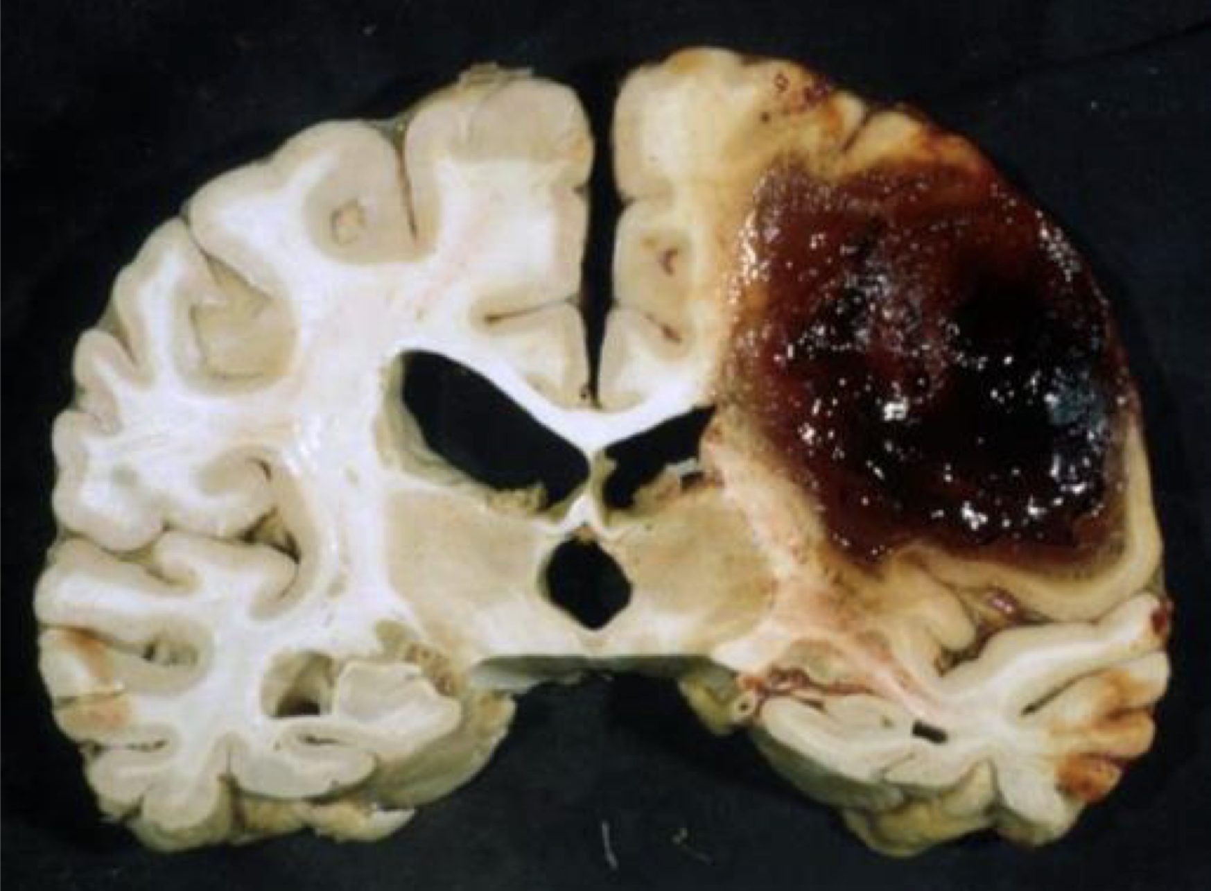 <p>Identify and type of necrosis</p>
