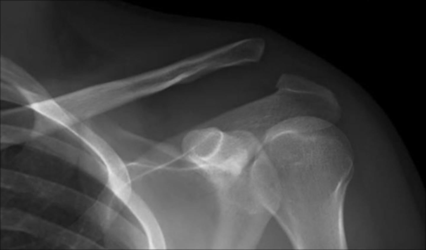 <p>disruption of acromioclavicular joint</p>