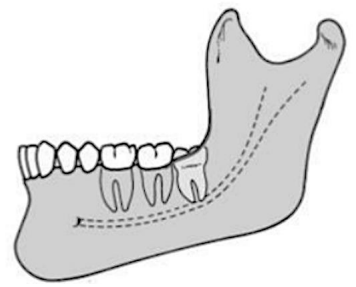 <p>occlusal plane is <span style="color: red;">between the occlusal plane and the cervical line </span>of the second molar</p>