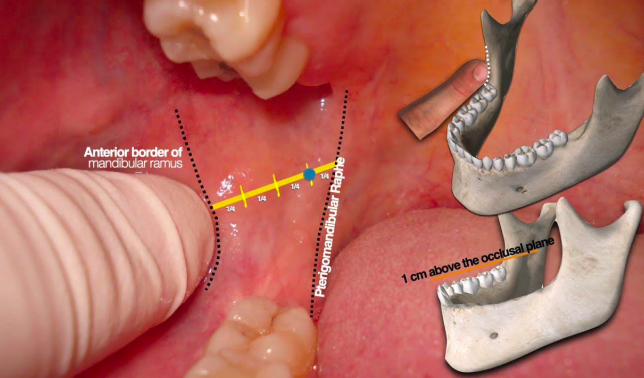 <p>is the most commonly affected muscles during an inferior alveolar nerve block</p>
