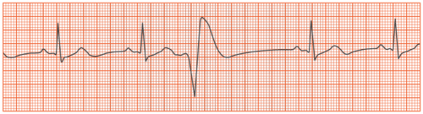 <p>B. Premature ventricular contraction</p>