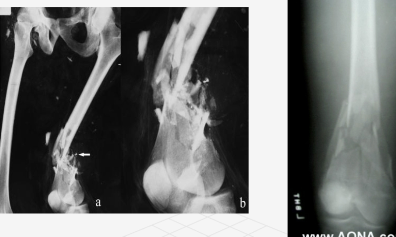 <p>what type of fracture</p>