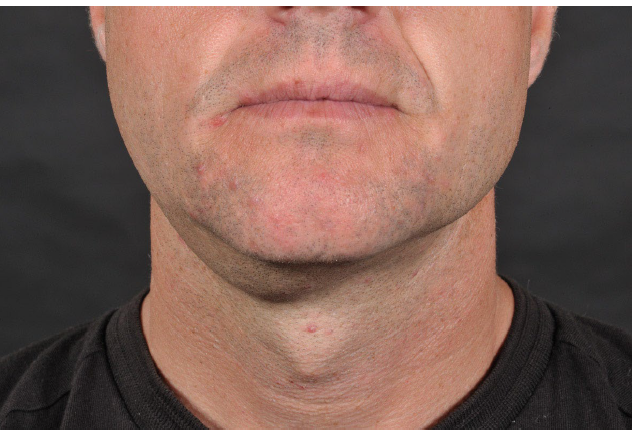 <p>cervical or plunging ranula</p>