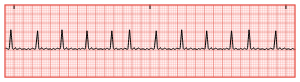 <ul><li><p>Thyroid panel (decreased TSH, increased T4…hyper)</p></li><li><p>CBC</p></li><li><p>Creatinine</p></li><li><p>Glucose</p></li><li><p>INR</p></li><li><p><span><strong>P waves</strong> are replaced by indiscernible <strong>(unidentifiable</strong>) atrial activity between QRS complexes. The ventricular rate can be within normal range (60 to 100/min) or increased range (100 to 200/min).</span></p></li></ul><p></p>